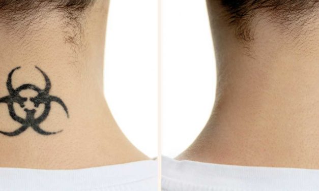 Home Tattoo Removal: Everything You Need To Know