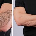 Laser Tattoo Removal: What Is It, How Does It Work, and Why Should I Do It