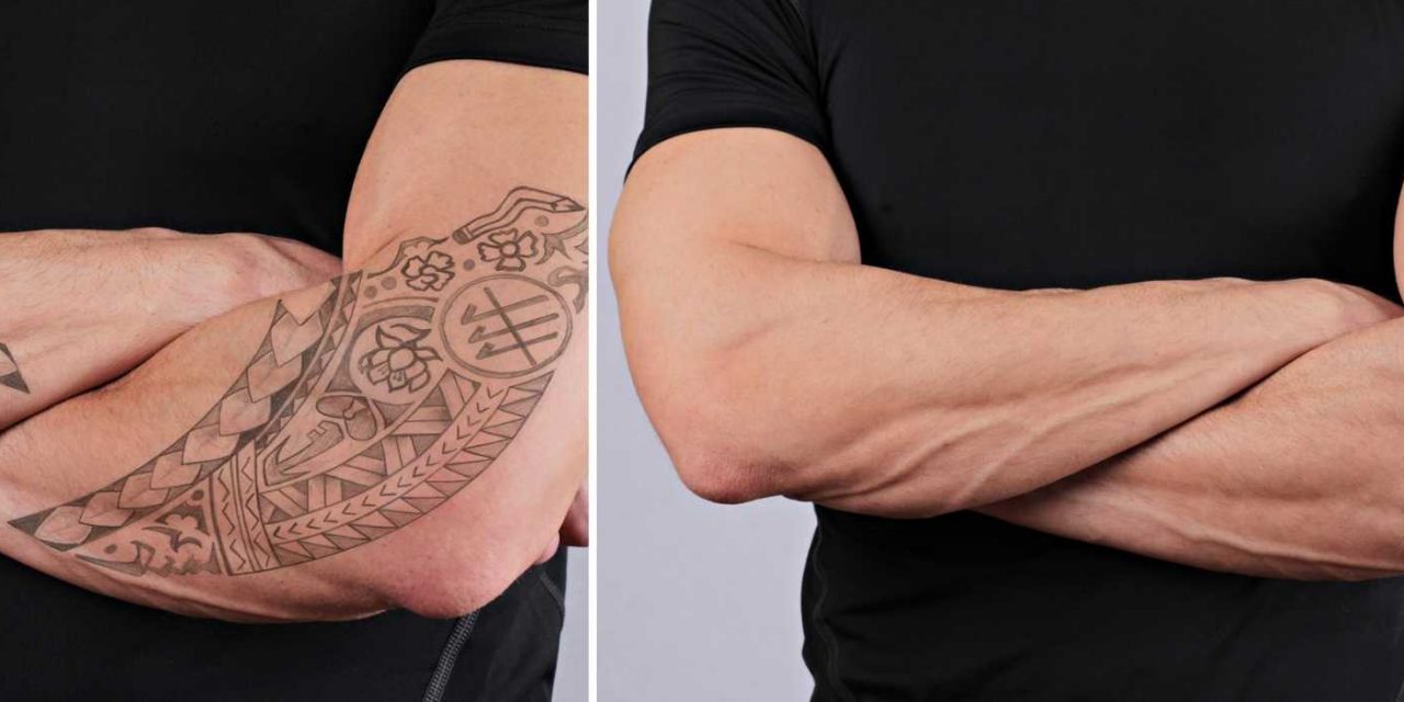 Laser Tattoo Removal: What Is It, How Does It Work, and Why Should I Do It?