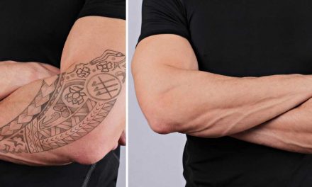 Laser Tattoo Removal: What Is It, How Does It Work, and Why Should I Do It?