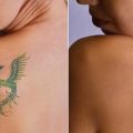 Skin Peels - An Effective Way of Dealing with Unwanted Tattoos