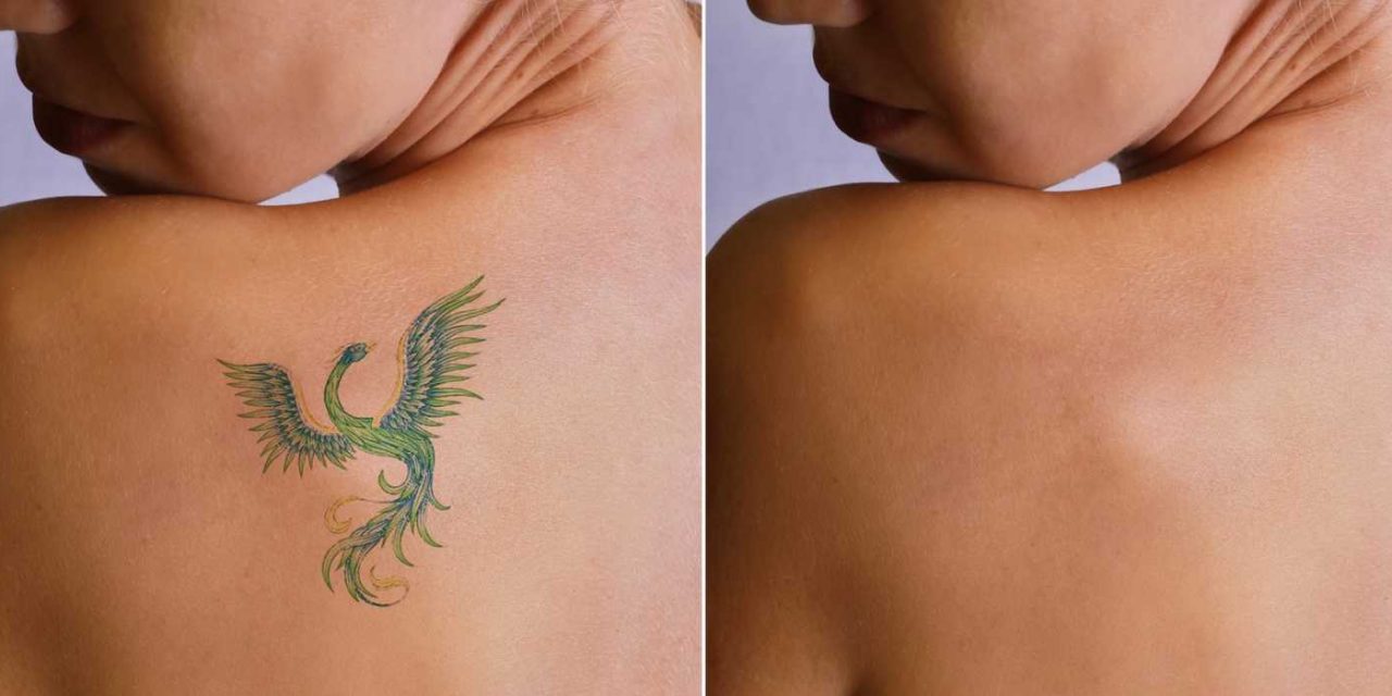 Skin Peels – An Effective Way of Dealing with Unwanted Tattoos