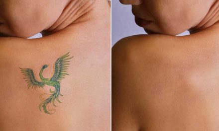 Skin Peels – An Effective Way of Dealing with Unwanted Tattoos