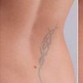 Tattoo Removal - Safe, Effective, Costly