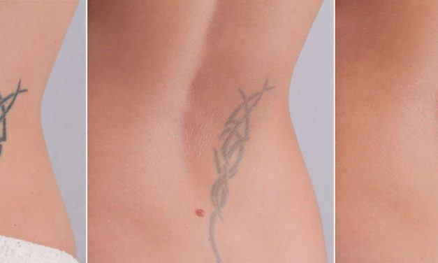 Tattoo Removal – Safe, Effective, Costly?