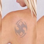 Use Tattoo Removal Lights to Successfully Remove Body Art in a Painless and Hassle Free Manner