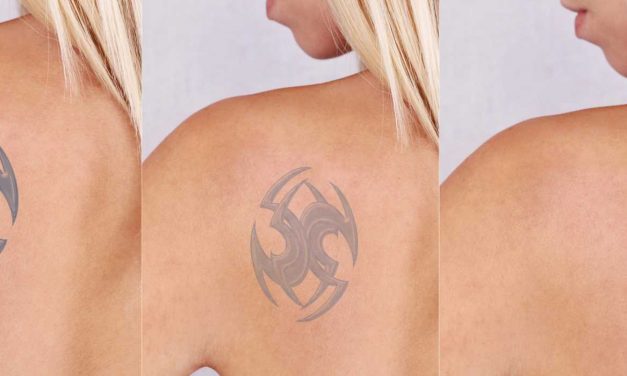 Use Tattoo Removal Lights to Successfully Remove Body Art in a Painless and Hassle Free Manner